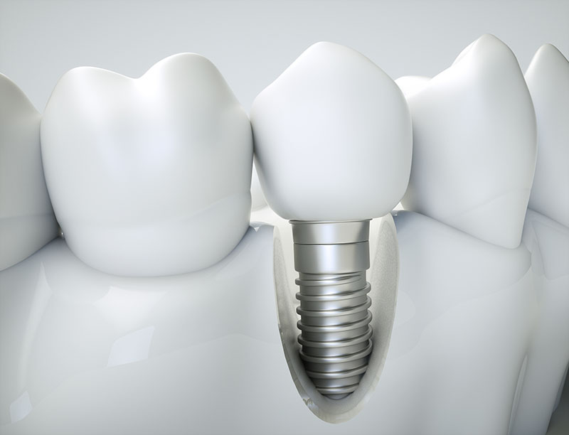 Dental implant illustration