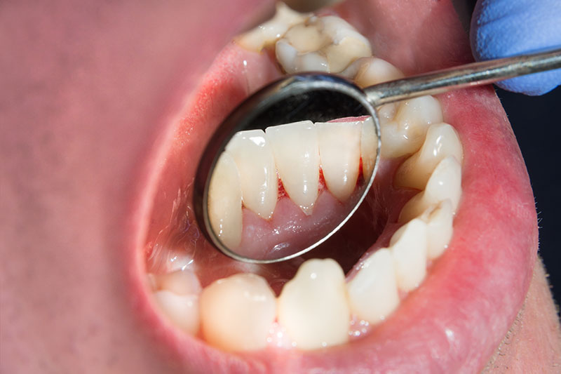 Close-up of gum disease treatment